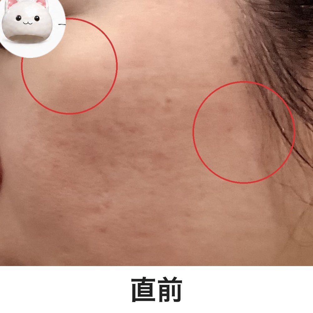 ピコレーザー直前の頬。目は猫で隠しています