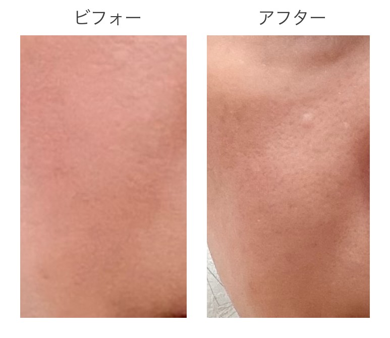 頬のビフォーアフター